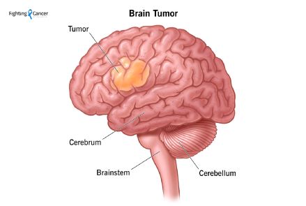 ব্রেইন টিউমার কী জীবনের জন্য হুমকির কারণ হয়ে দাঁড়াতে পারে?