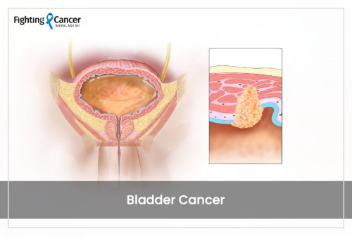 মূত্রাশয়ের ক্যান্সার